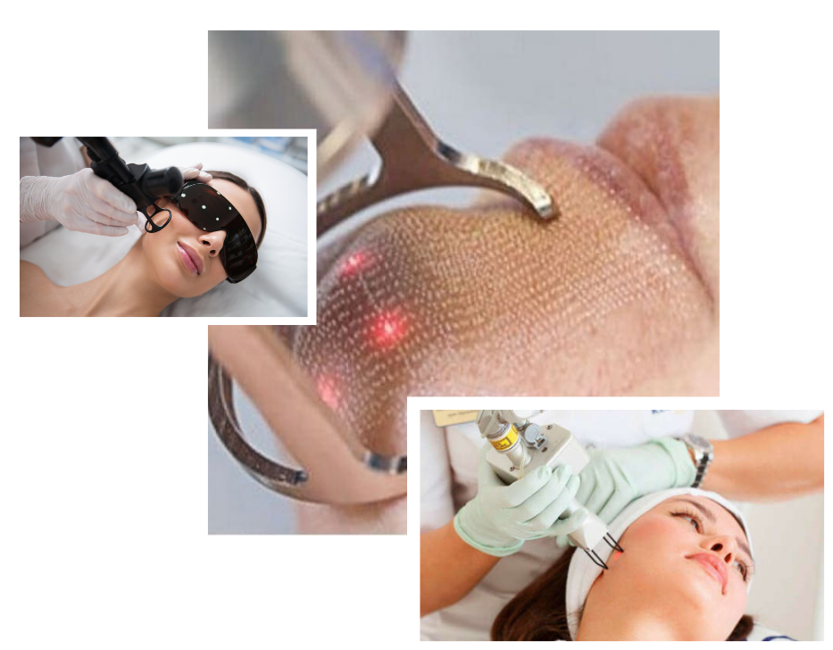 Ablative Erbium YAG Laser in London