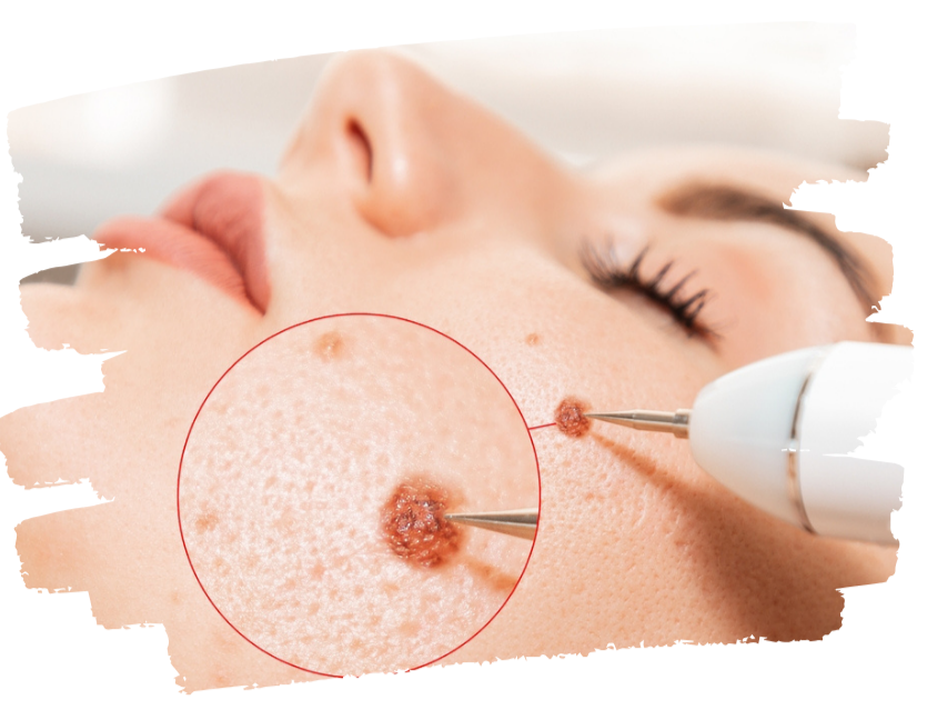 Benefits of Skin Tag Removal