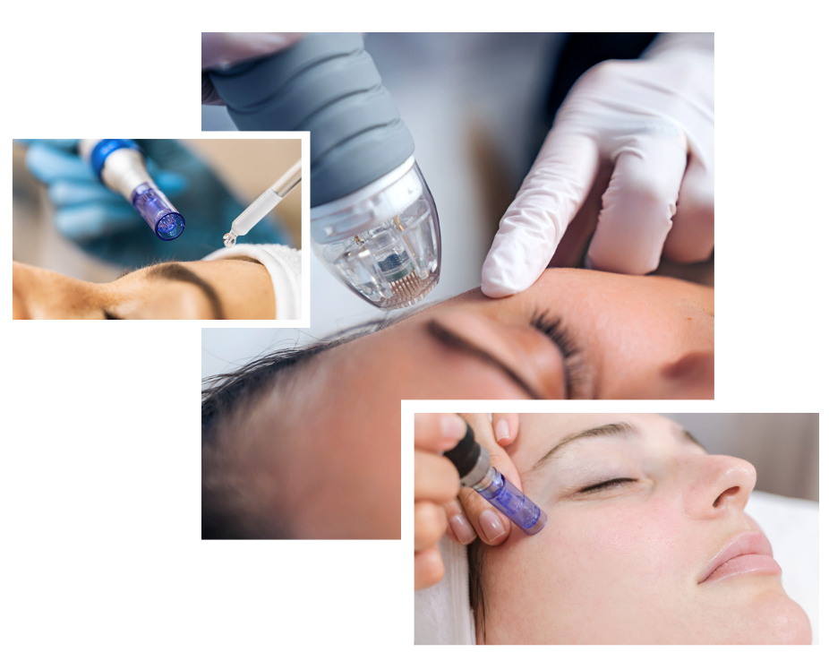 Microneedling London