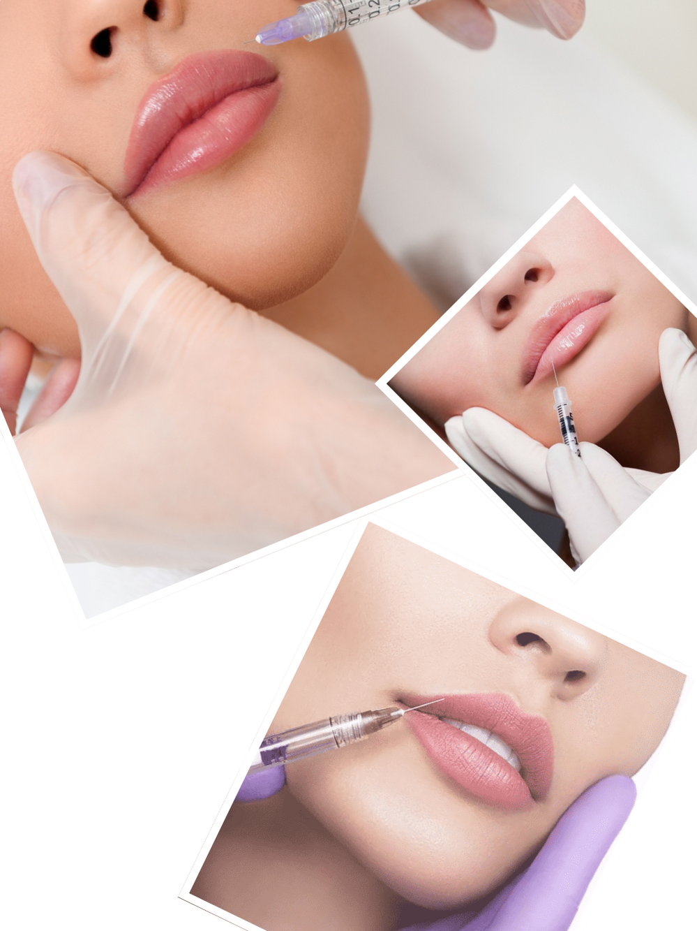 Our Signature Lip Filler Process