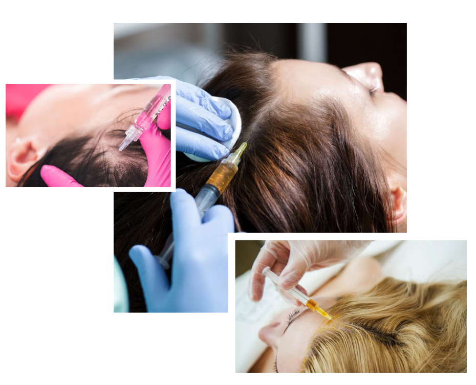Prp Hair Treatment in London