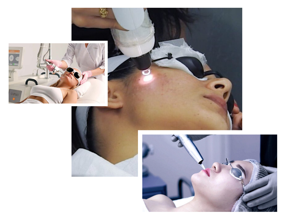 Q-Switch NdYAG Laser in London