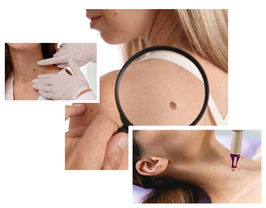 Skin Tag Removal in London
