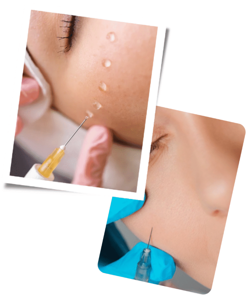 Who Is Cheek Filler Suitable For