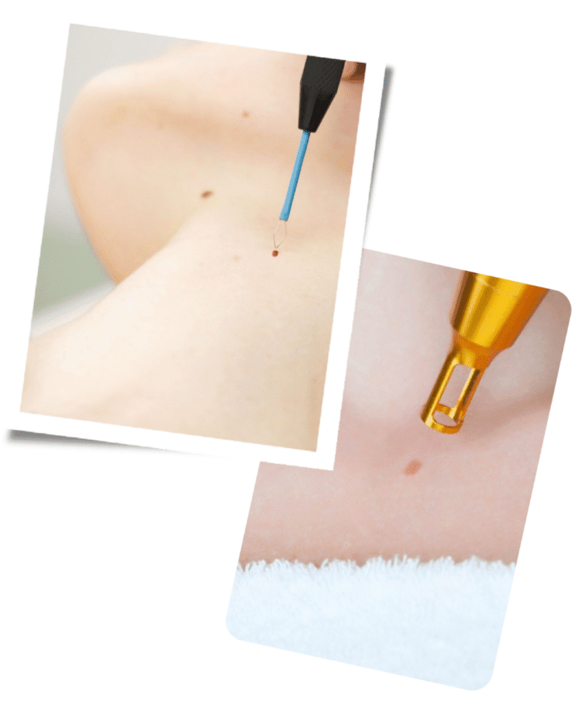 Who Is Skin Tag Removal Suitable For