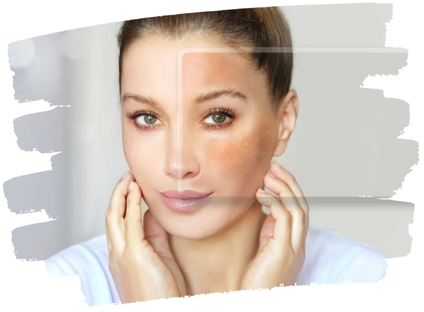 Benefits of Melasma Treatment