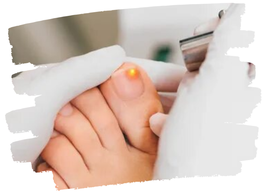 Benefits of Nail Fungus Treatment