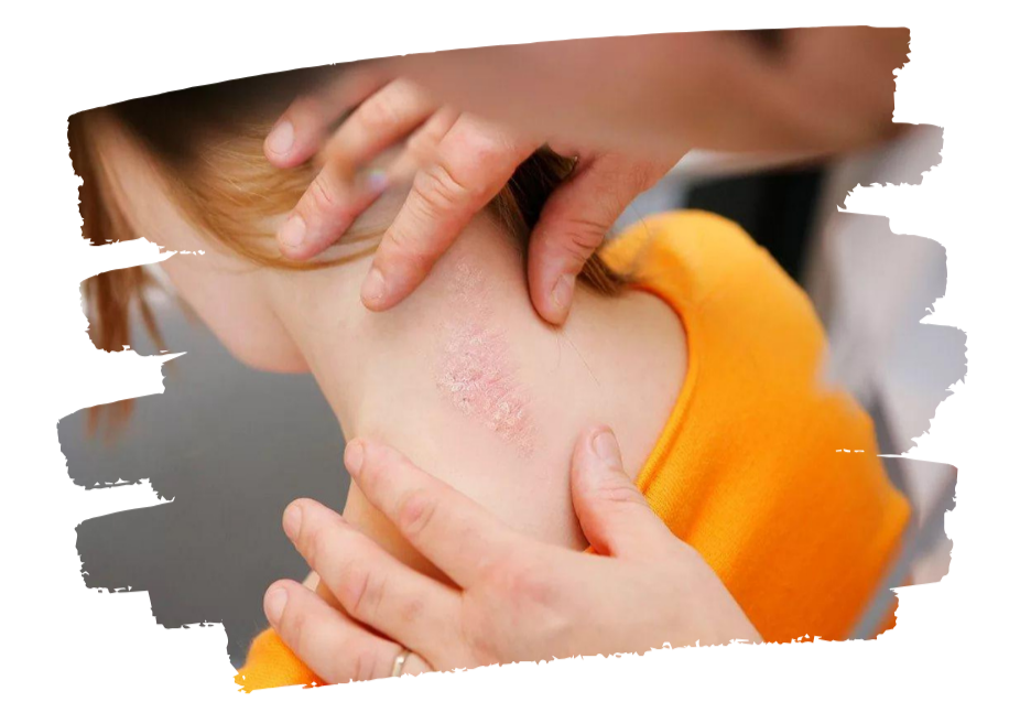 Benefits of Psoriasis Treatment