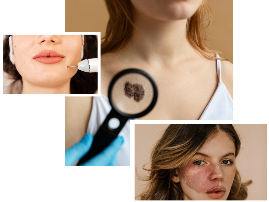 Birthmark Removal in London