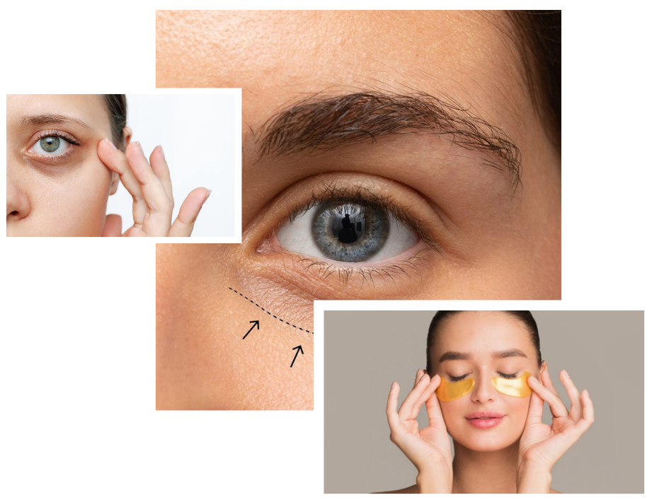 Dark Circle Treatment in London