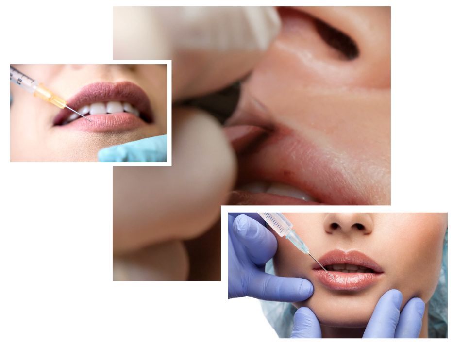 Dark Lips Treatment in London