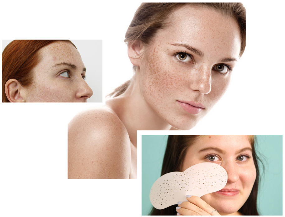 Freckle Treatment in London