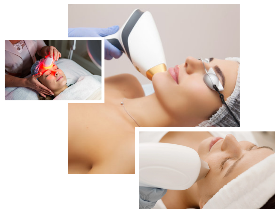 Intense Pulsed Light (IPL) Treatment in London