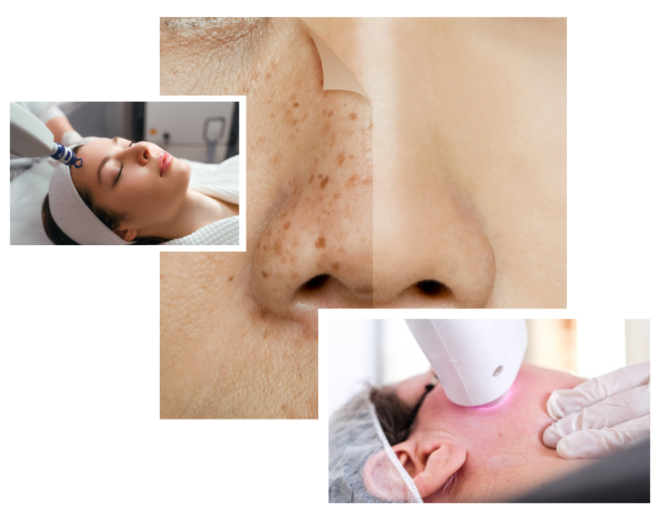 Melasma Treatment in London
