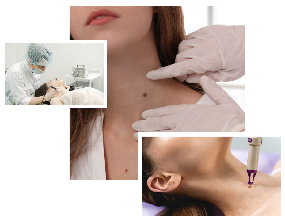 Mole Removal in London