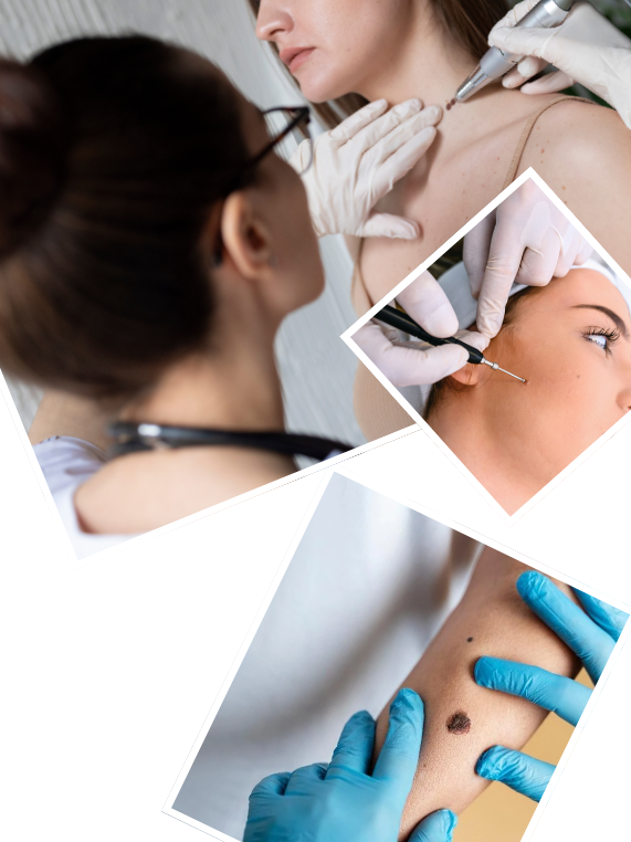 Our Signature Birthmark Removal Process