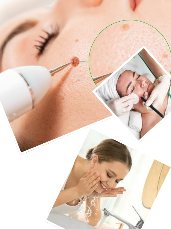 Our Signature Cautery Fulguration Treatment Process