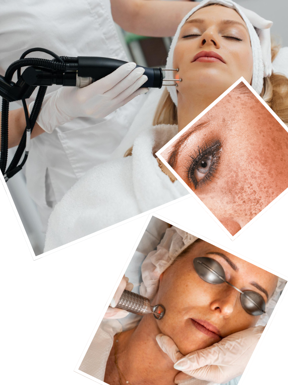 Our Signature Melasma Treatment Process