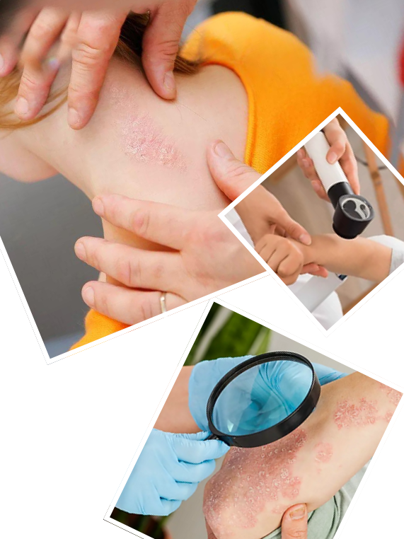 Our Signature Psoriasis Treatment Process
