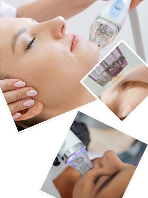 Our Signature RF Microneedling Process