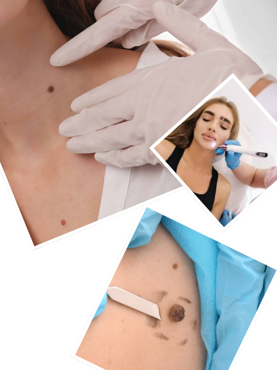 Our Signature Skin Tag Removal Process