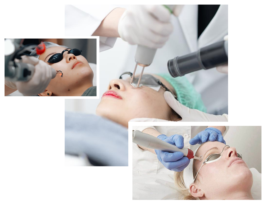 Pico Laser Treatment in London