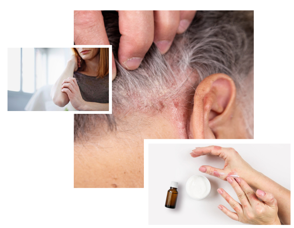 Psoriasis Treatment in London