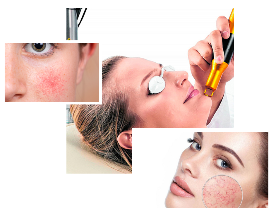 Rosacea Treatment in London