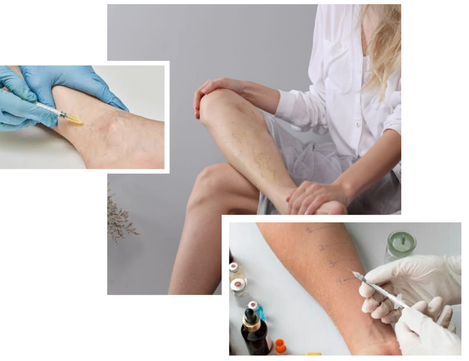 Thread Vein in London