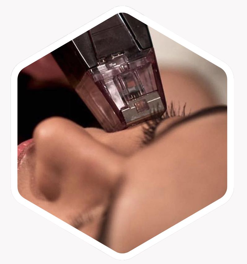 Who Is Morpheus8 Suitable For