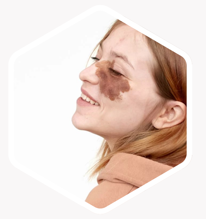 Who is Birthmark Removal Suitable For