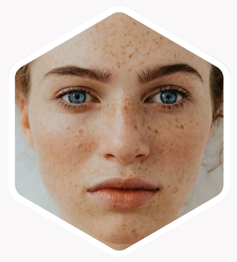 Who is Freckle Treatment Suitable For