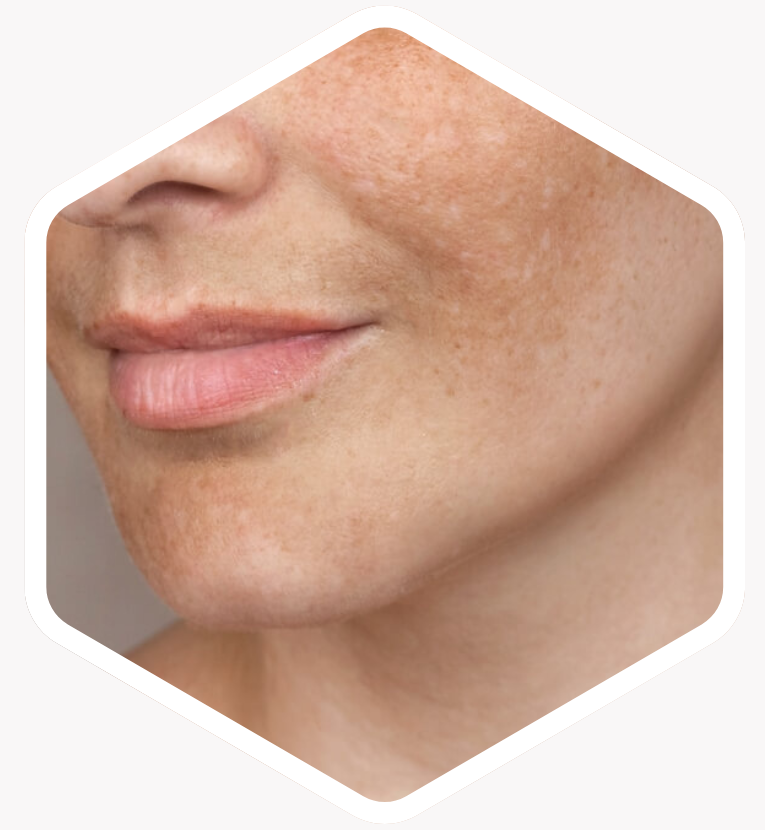 Who is Melasma Treatment Suitable For