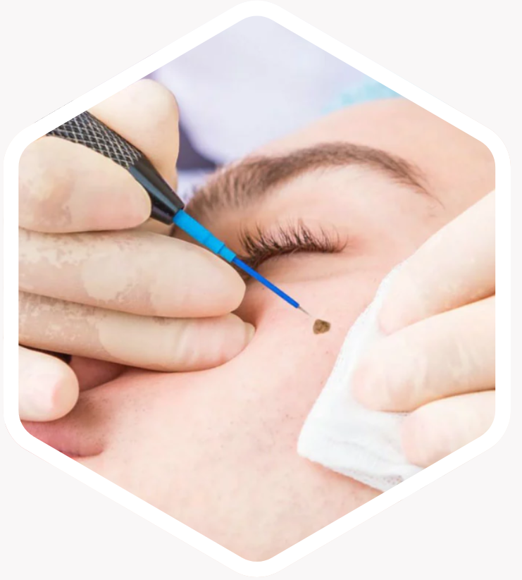 Who is Mole Removal Suitable For