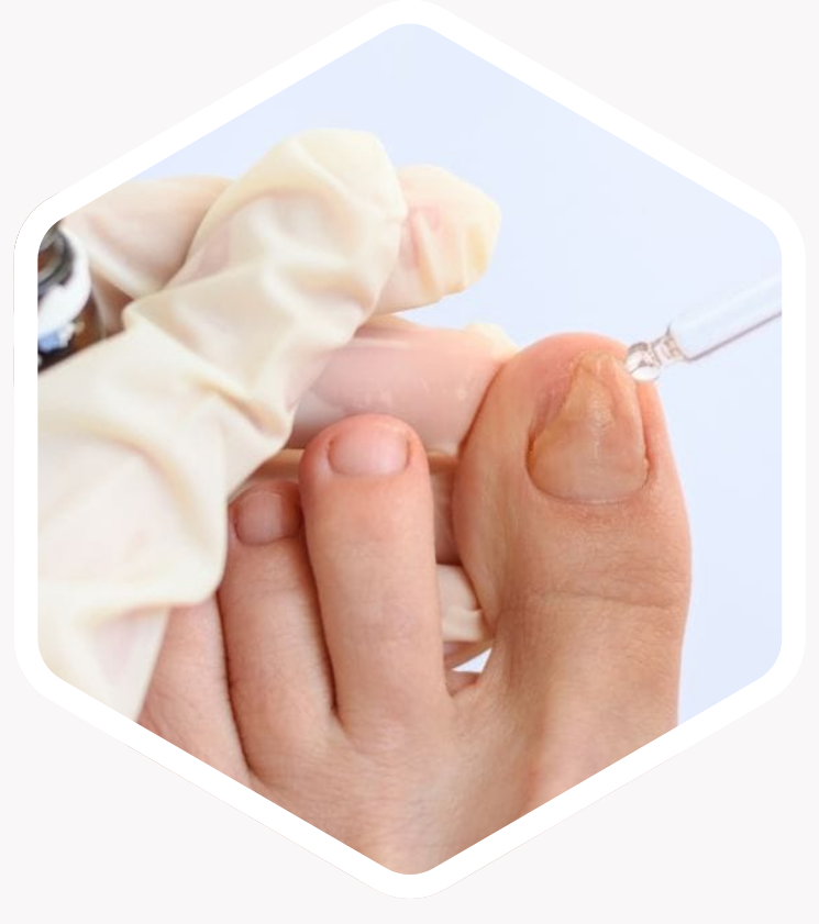 Who is Nail Fungus Treatment Suitable For