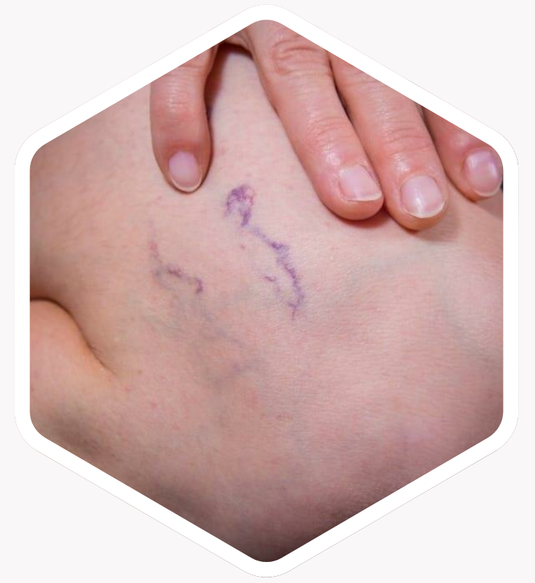 Who is Thread Vein Treatment Suitable For