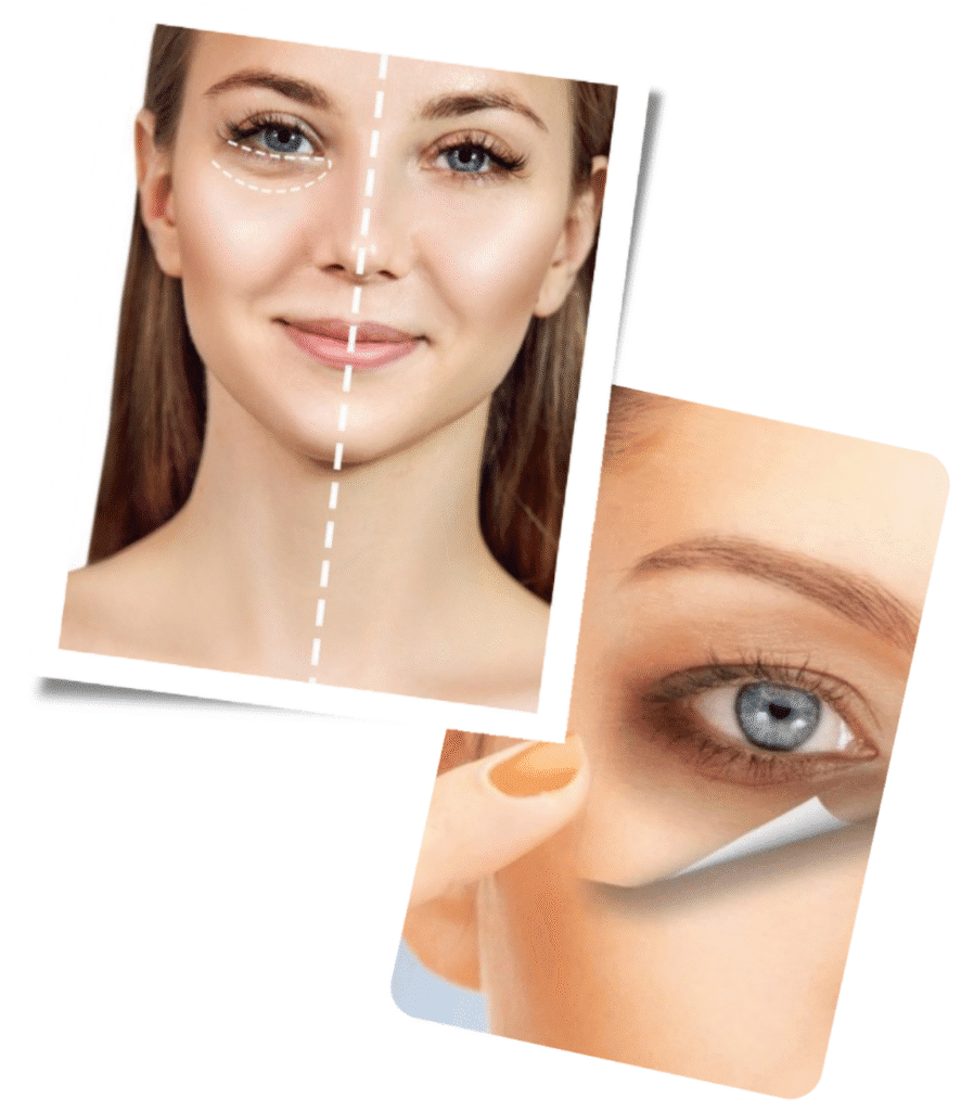 Why Choose Our London Clinic for Dark Circle Treatment