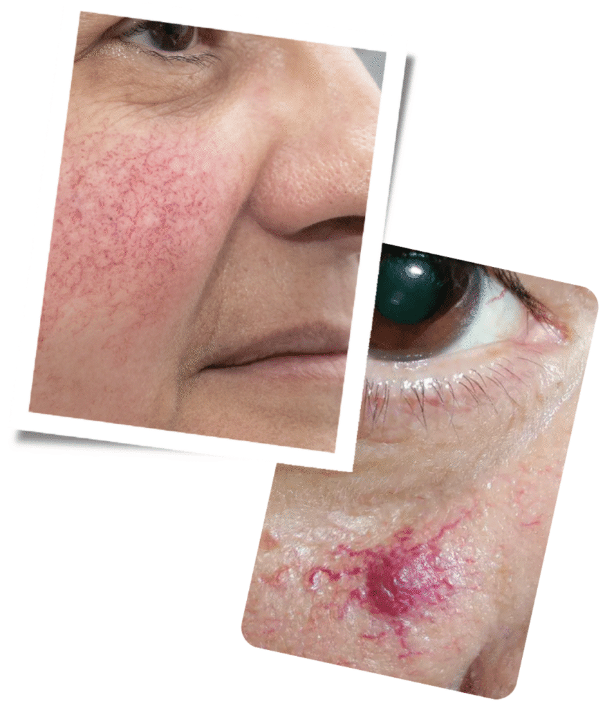 Why Choose Our London Clinic for Thread Vein Treatment